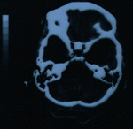 headscan